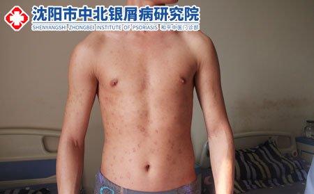 沈陽治療牛皮癬醫院