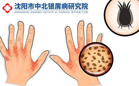 沈陽專業治療銀屑病醫院收費高不