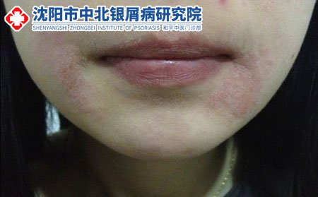 沈陽中北銀屑病研究院網上咨詢