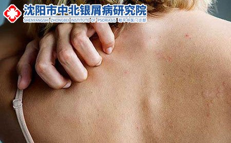 沈陽中北銀屑病研究院管用嗎