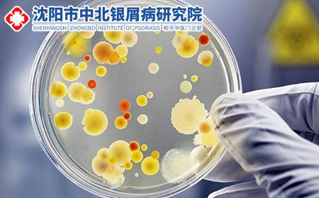 沈陽中北銀屑病研究院好嗎