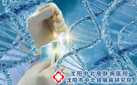 沈陽中北銀屑病醫院收費高嗎