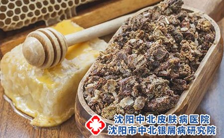 銀屑病有哪些明顯癥狀